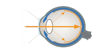Defokus-mit-Kontaktlinsen