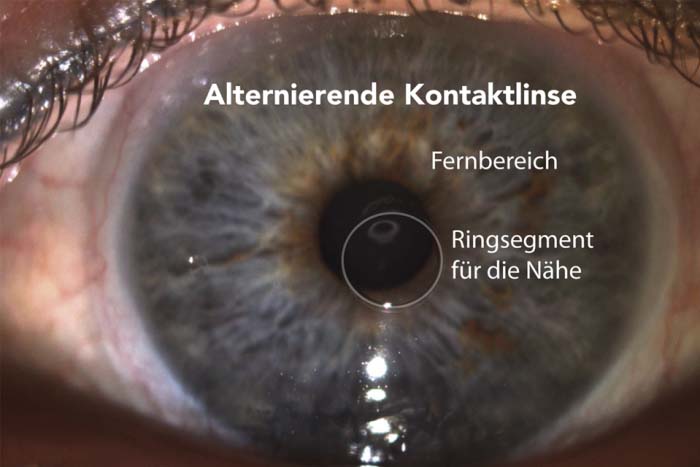Nahaufnahme von Auge mit alternierender Kontaktlinse